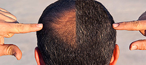 Hair Transplant Before & After Photos