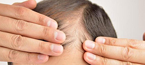 Houston Hair Transplant | Dr. Jezic - Hair Restoration