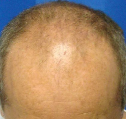 Hair Transplants Before & After Patient #933