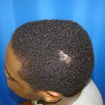 Hair Transplants Before & After Patient #939