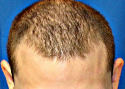 Hair Transplants Before & After Patient #942