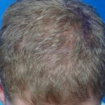 Hair Transplants Before & After Patient #945