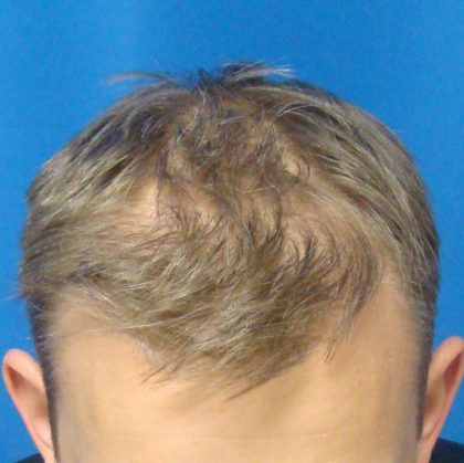 Hair Transplants Before & After Patient #960