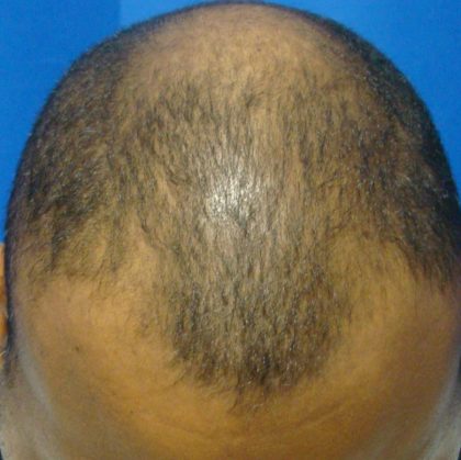 Hair Transplants Before & After Patient #967