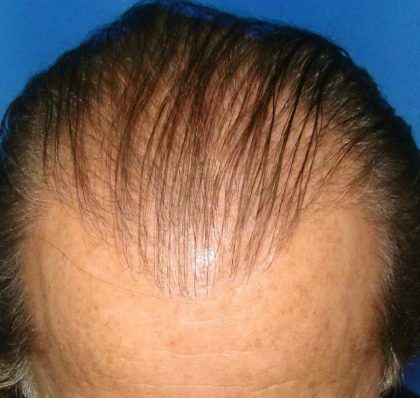 Hair Transplants Before & After Patient #933