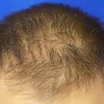 Hair Transplants Before & After Patient #950