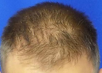 Hair Transplants Before & After Patient #950