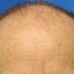 Hair Transplants Before & After Patient #933