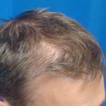 Hair Transplants Before & After Patient #960