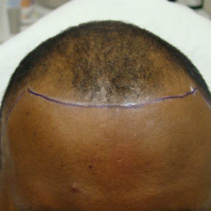 Hair Transplants Before & After Patient #967