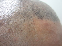 Hair Line Scalp Micropigmentation FUT Scar