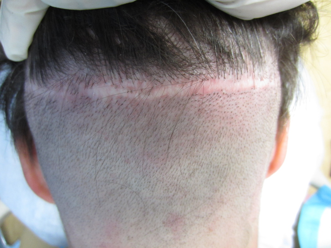 Hairphysician, Hair Transplant Scar, Houston Texas