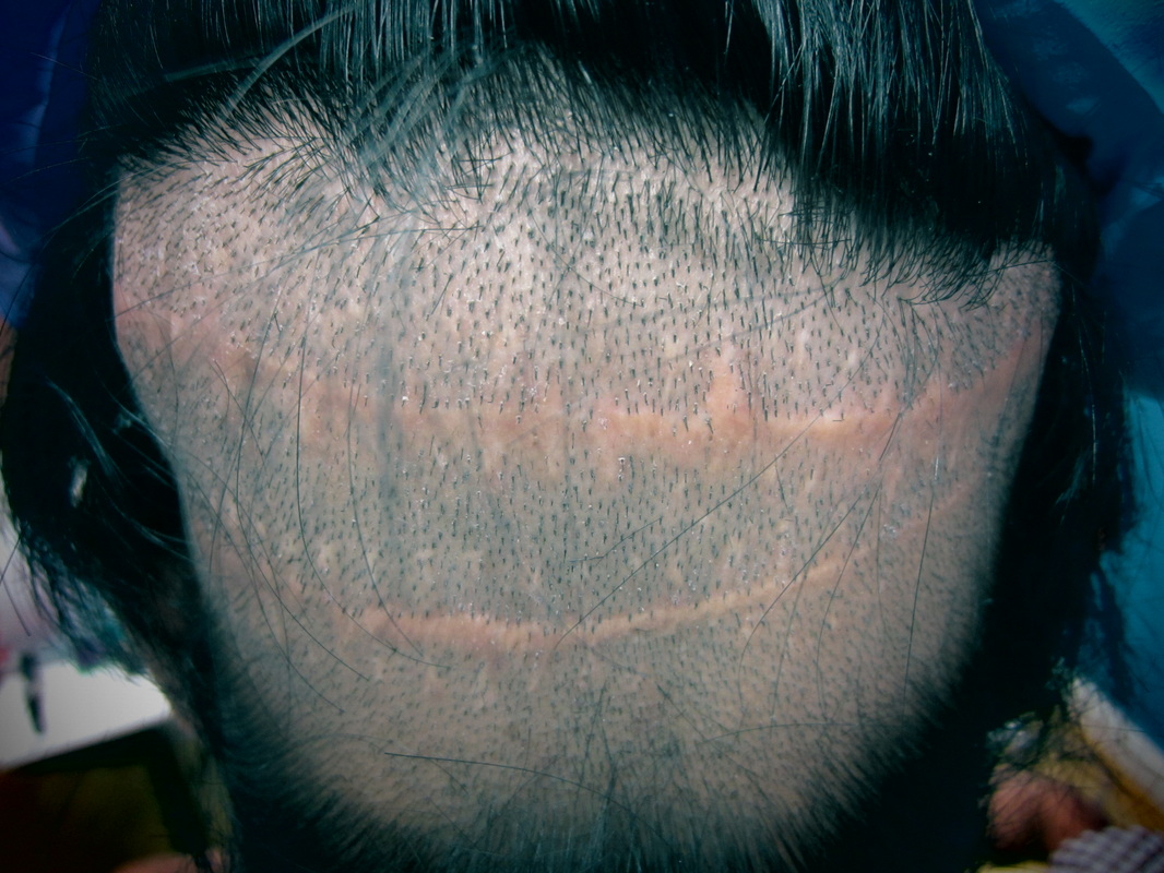 Dr. Jezic Offers Houston's Elite Hair Transplant. - Houston Hair Transplant | Dr. Jezic Dr. Jezic Offers Houston's Elite Hair Transplant. - Houston Hair Transplant | Dr. Jezic