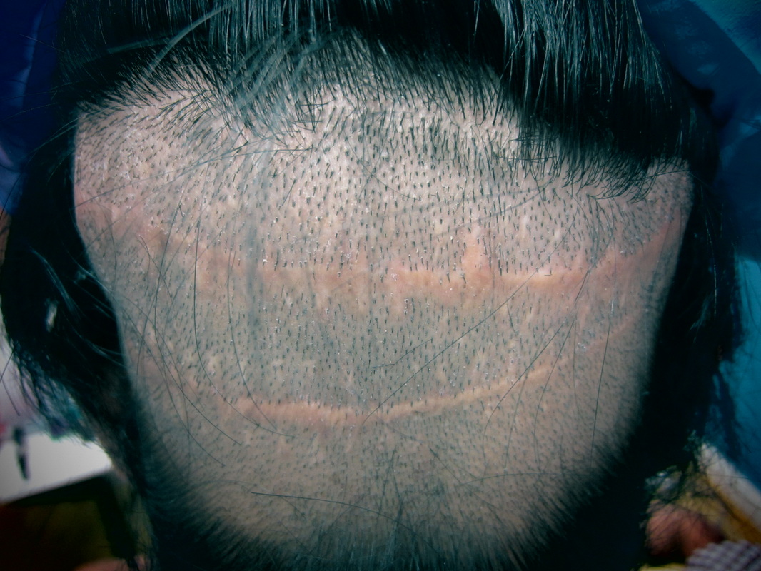 Hairphysician, Hair Transplant Scar, Houston Texas