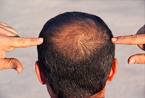 Does Restoration Make Sense? - Houston Hair Restoration | Dr. Jezic