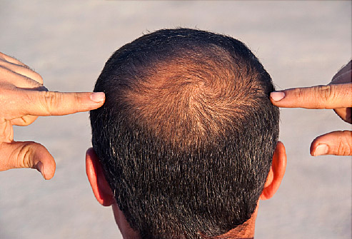 Does Restoration Make Sense? - Houston Hair Restoration | Dr. Jezic Does Restoration Make Sense? - Houston Hair Restoration | Dr. Jezic