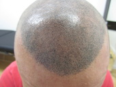 Scalp Micro-Pigmentation Houston Hair Transplant Center