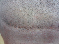 Scalp Micropigmentation into a Hair Transplant FUT Scar