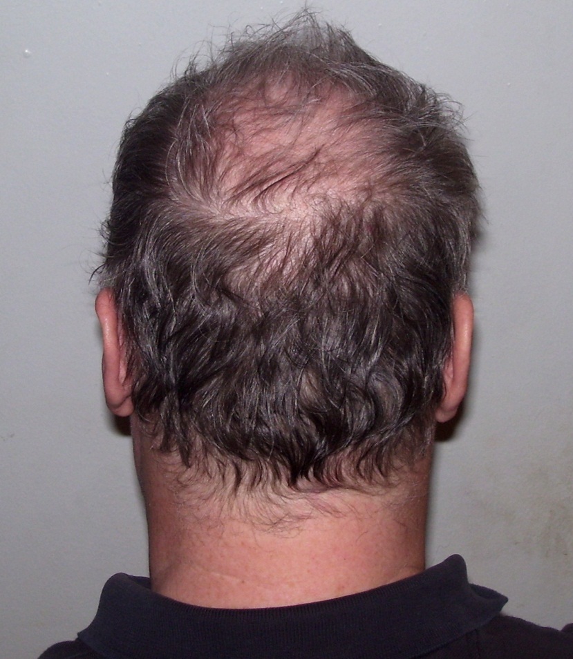 Hair Loss Transplant Houston Texas