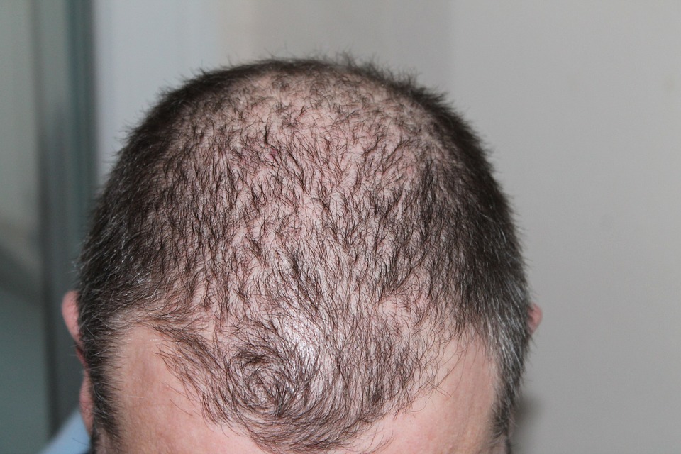 Hair Transplant Permanent Houston