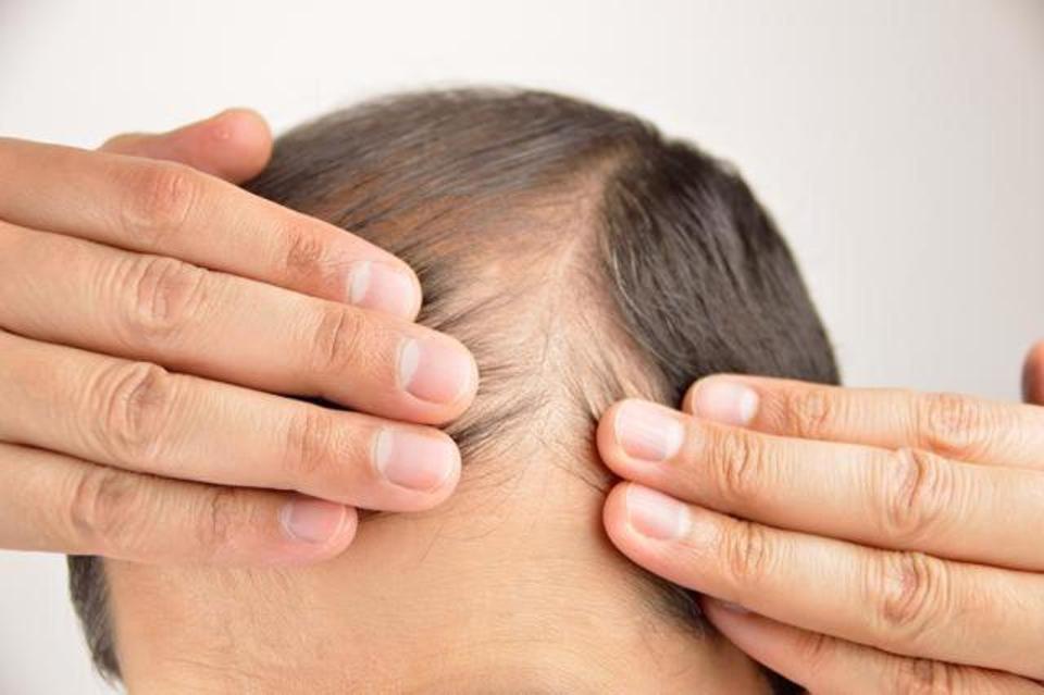Male Pattern Baldness - Causes and Treatments Male Pattern Baldness - Causes and Treatments