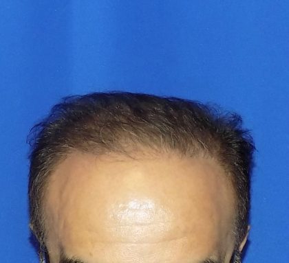 Hair Transplants Before & After Patient #1196