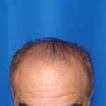 Hair Transplants Before & After Patient #1196
