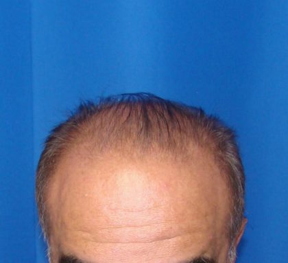 Hair Transplants Before & After Patient #1196