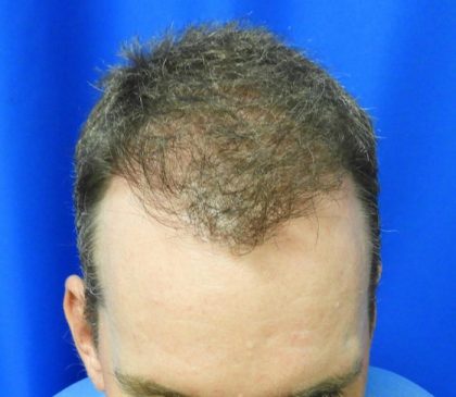 Hair Transplants Before & After Patient #1223