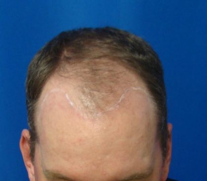 Hair Transplants Before & After Patient #1223