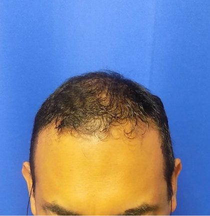 Hair Transplants Before & After Patient #1243