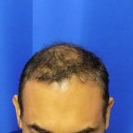 Hair Transplants Before & After Patient #1243
