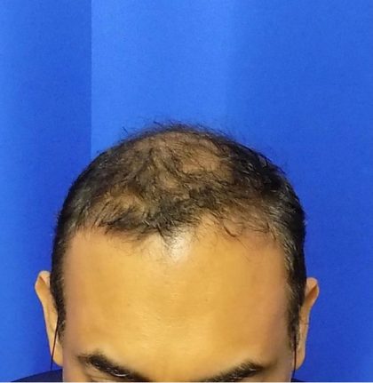 Hair Transplants Before & After Patient #1243