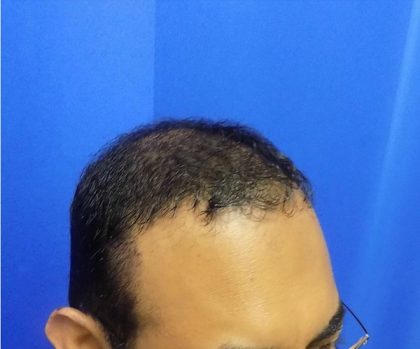 Hair Transplants Before & After Patient #1243