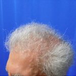 Hair Transplants Before & After Patient #1242
