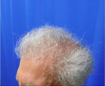 Hair Transplants Before & After Patient #1242