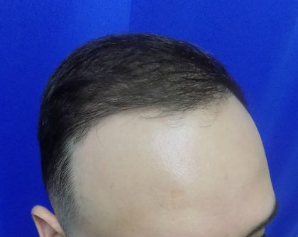 Hair Transplants Before & After Patient #1374