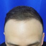 Hair Transplants Before & After Patient #1374