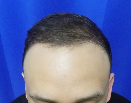 Hair Transplants Before & After Patient #1374