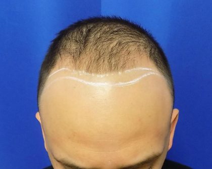 Hair Transplants Before & After Patient #1374