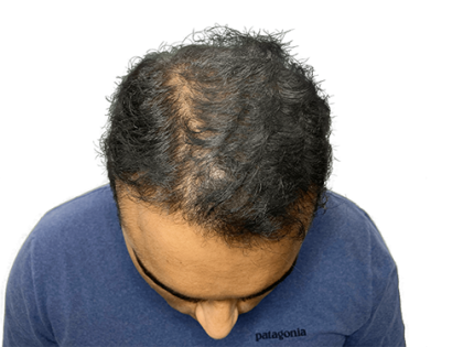 Hair Transplants Before & After Patient #2079