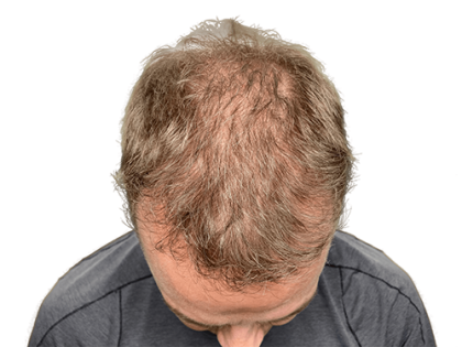 Hair Transplants Before & After Patient #2129