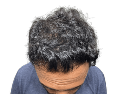 Hair Transplants Before & After Patient #2027