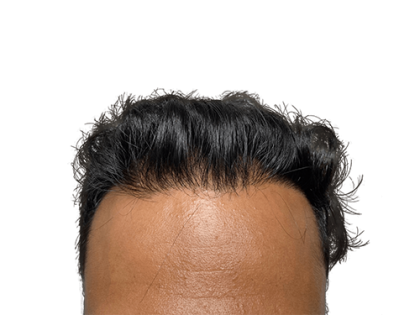 Hair Transplants Before & After Patient #2027