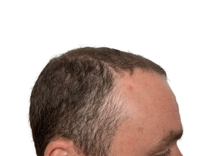 Hair Transplants Before & After Patient #2132
