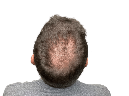 Hair Transplants Before & After Patient #2129