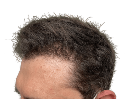 Hair Transplants Before & After Patient #2210