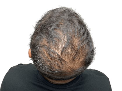 Hair Transplants Before & After Patient #2079