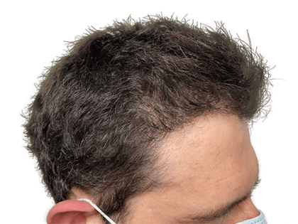 Hair Transplants Before & After Patient #2210