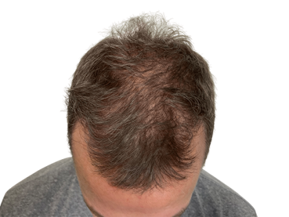 Hair Transplants Before & After Patient #2129